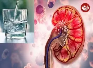 چرا نوشیدن آب برای جلوگیری از سنگ کلیه کافی نیست؟