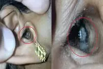 (ویدئو) لحظه خروج ترسناک عنکبوت سمی از داخل گوش یک مرد
