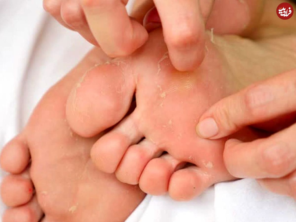 چرا کف پا پوسته پوسته میشود؟