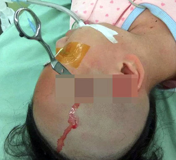 تصاویر/ پدر بی‌رحم قیچی را در سر دختر 10 ساله‌اش فرو کرد