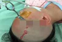 تصاویر/ پدر بی‌رحم قیچی را در سر دختر 10 ساله‌اش فرو کرد