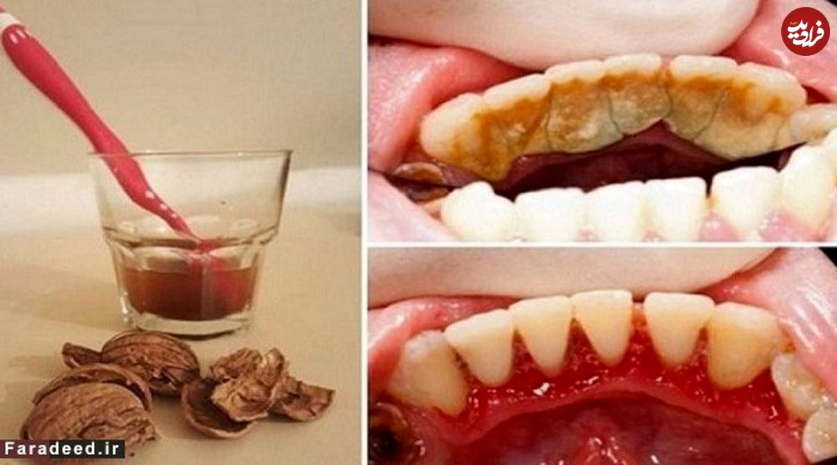 چگونه جرم دندان را بدون هزینه از بین ببریم؟
