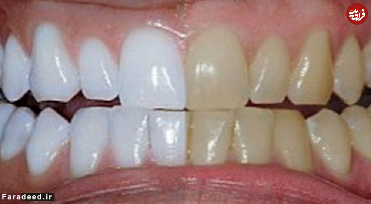 سفید کردنِ بدون دردسر دندان