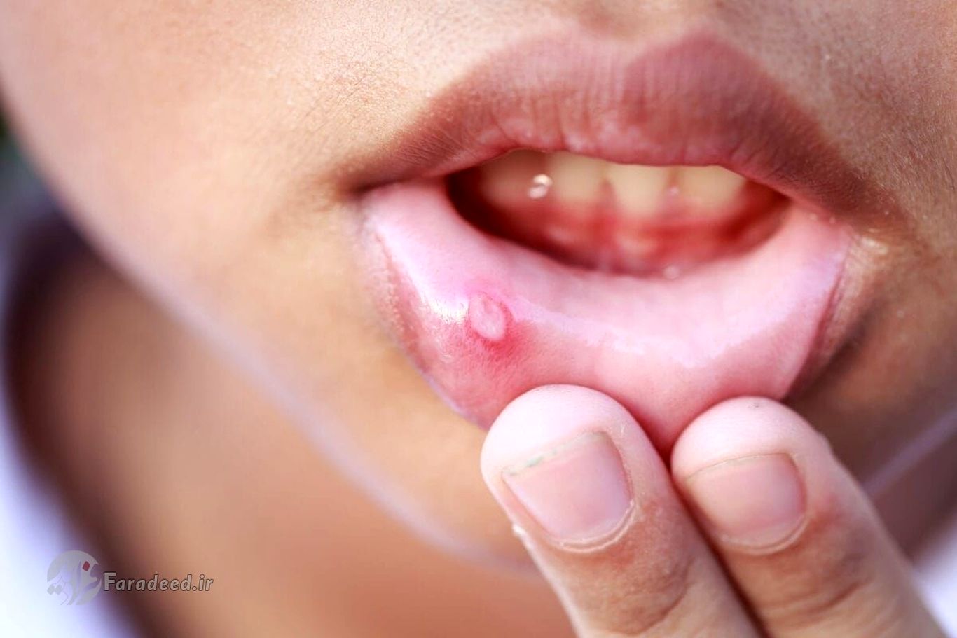 درمان آفت دهان کودک؛ علت آفت دهان کودکان چیست؟