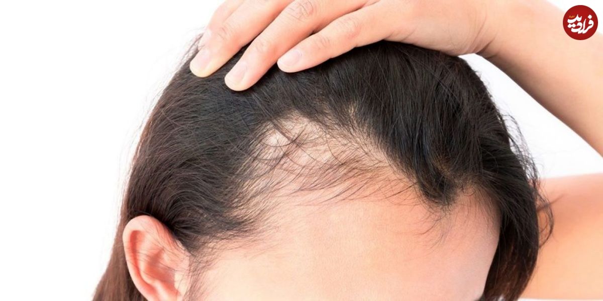 کدام ویتامین‌ها در درمان ریزش مو موثر هستند؟