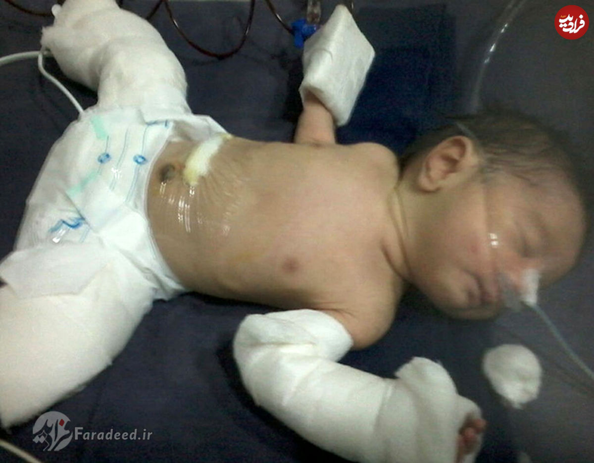 تصاویر/ تولد نوزاد باردار در هند!
