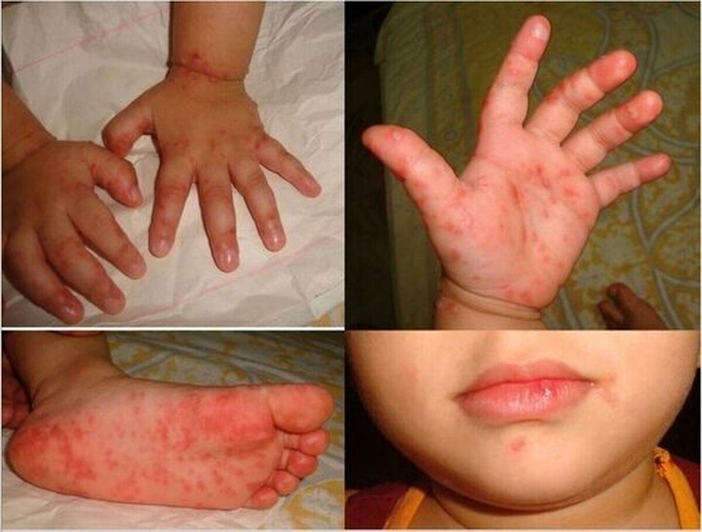 شیوع بیماری عجیب «دست و پا و دهان»؛ کودکان میزبان اصلی ویروس!