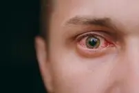 چشم صورتی؛ علامت عجیب ابتلا به اومیکرون