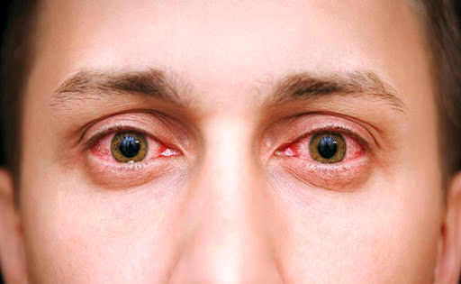 تشدید بیماری‌های چشم در دوران کرونا