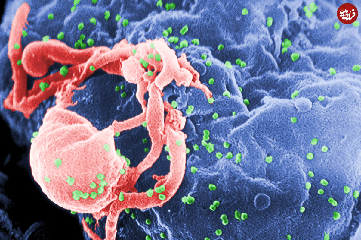 یک التهاب جدید در افراد مبتلا به ایدز