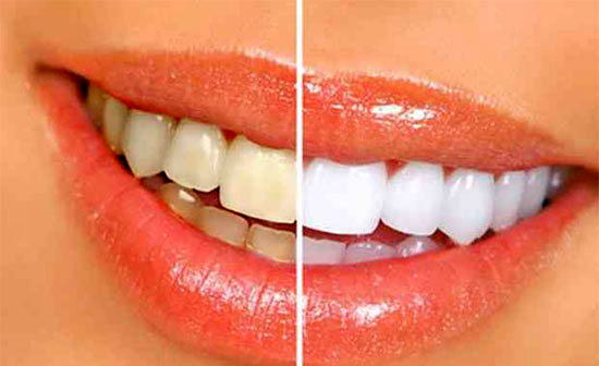 زردی دندان‌ها نشانه چیست؟