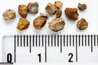 مهمترین علائم سنگ کلیه