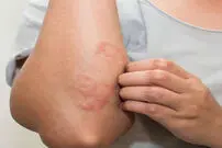 "التهابات پوستی"، نشانه جدید کرونا
