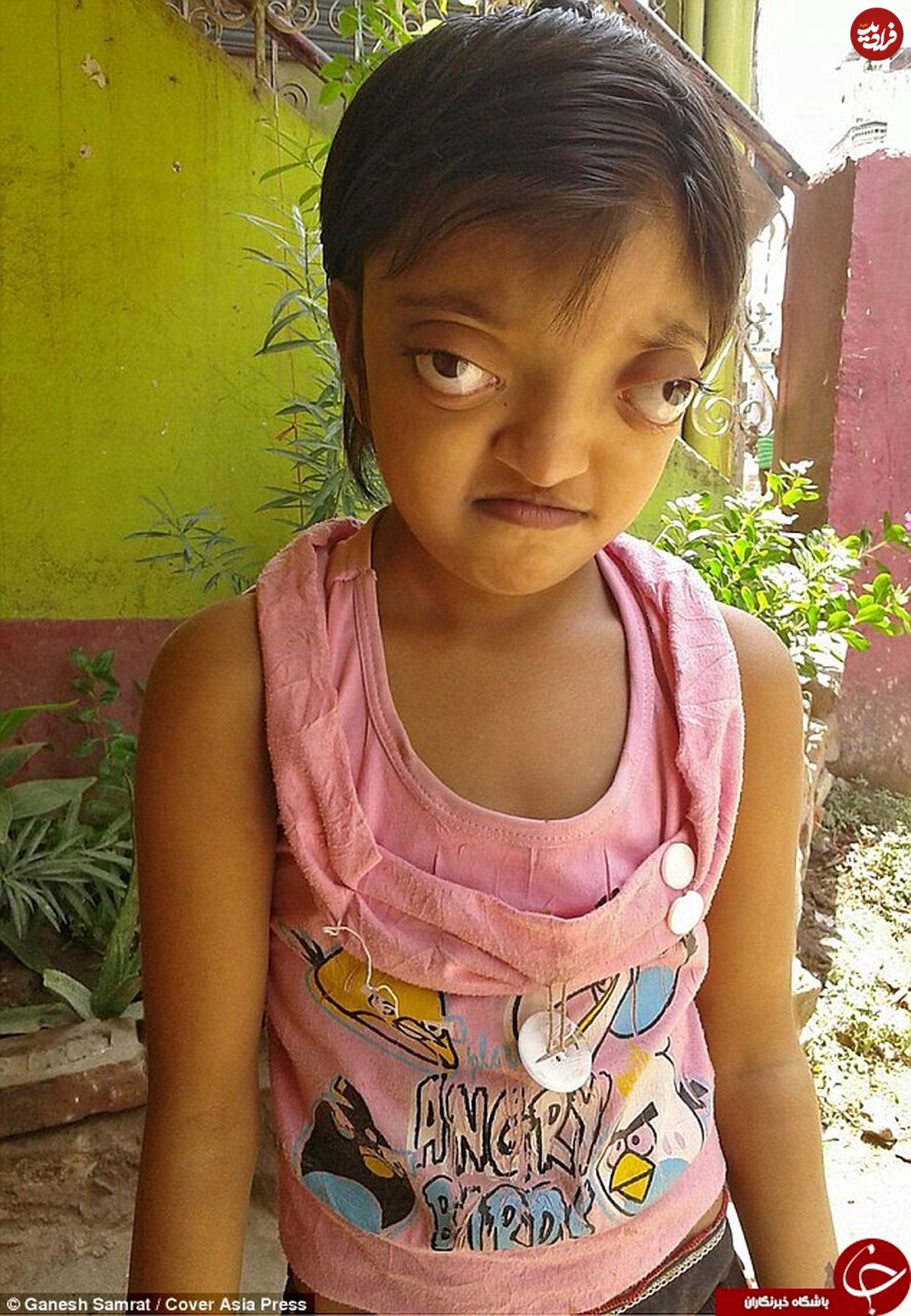 تصاویر/ بیماری نادر یک دختر بچه