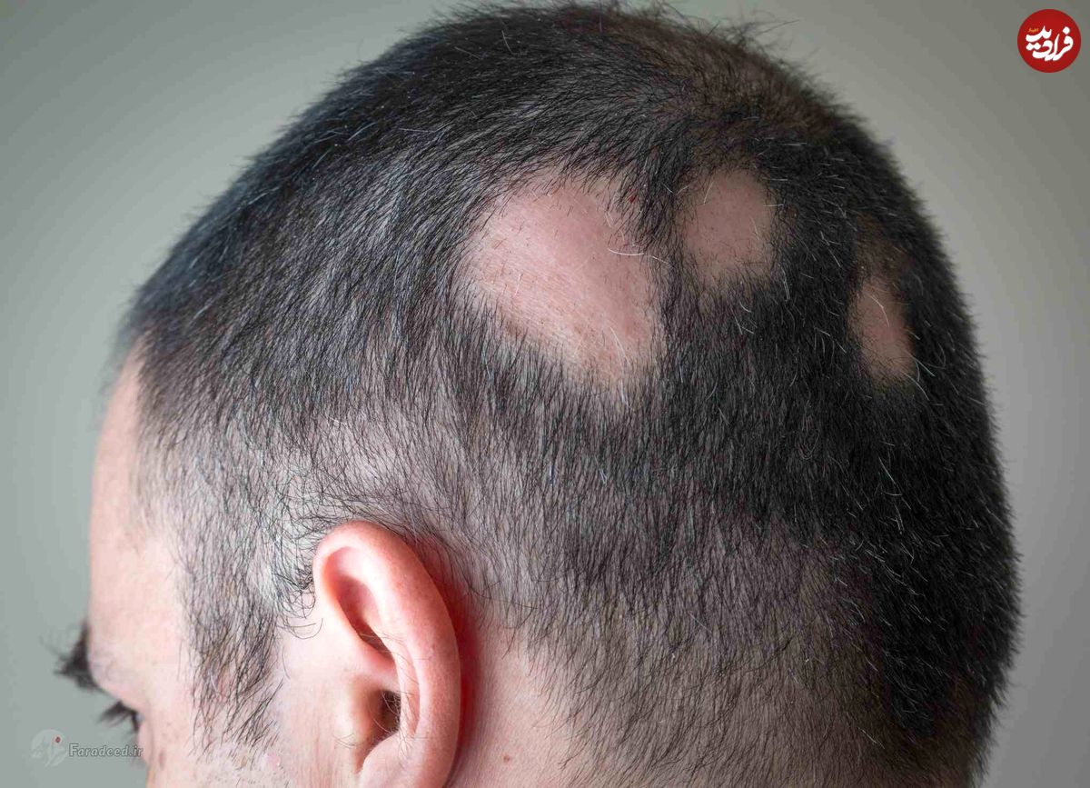 درمان ریزش موی سکه‌ای؛ علت ریزش موی سکه‌ای چیست؟
