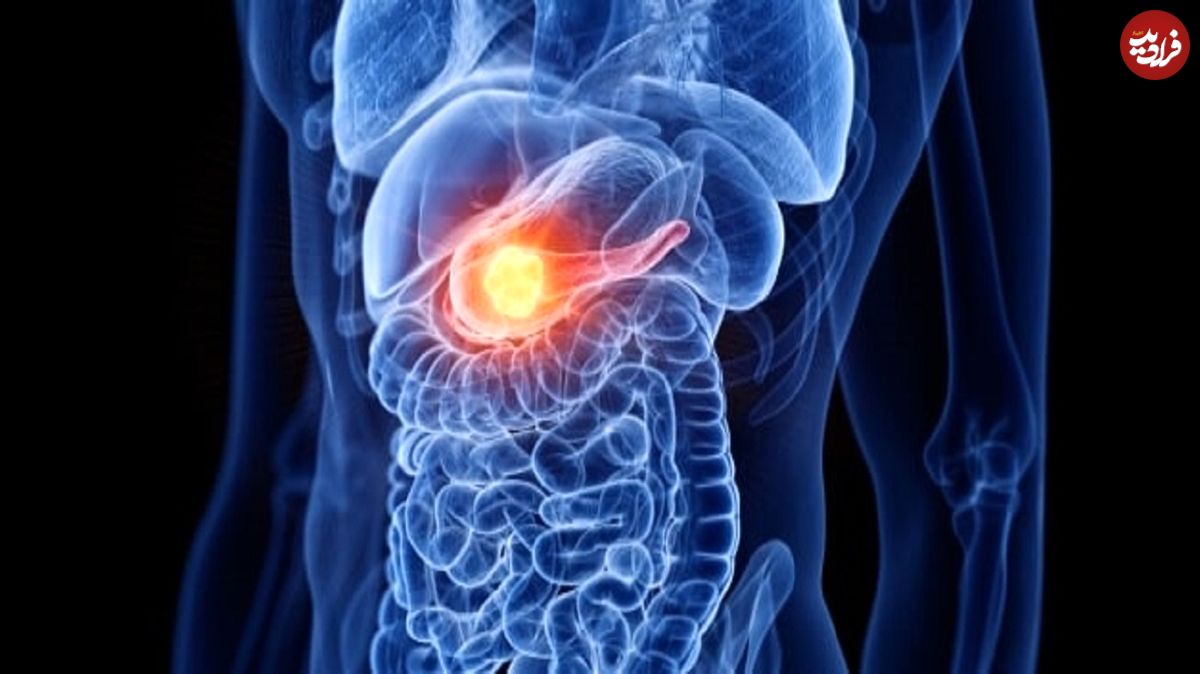 درمان سرطان پانکراس؛ این ایمپلنت دارو را به تومور‌ها می‌رساند