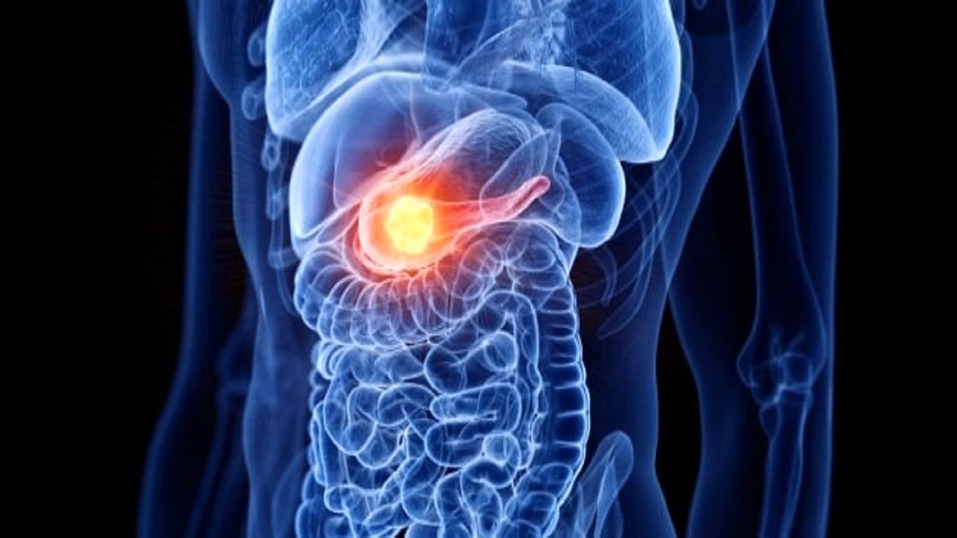 درمان سرطان پانکراس؛ این ایمپلنت دارو را به تومور‌ها می‌رساند