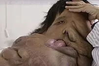 تصاویر/ مرد فیلی با ۱۵کیلو زائده گوشتی در صورت