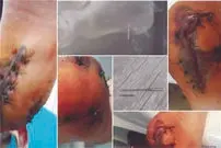سوزنی که حادثه‌ساز شد