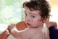 آبله مرغان تا چند روز واگیر دارد؟