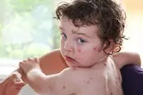 آبله مرغان تا چند روز واگیر دارد؟