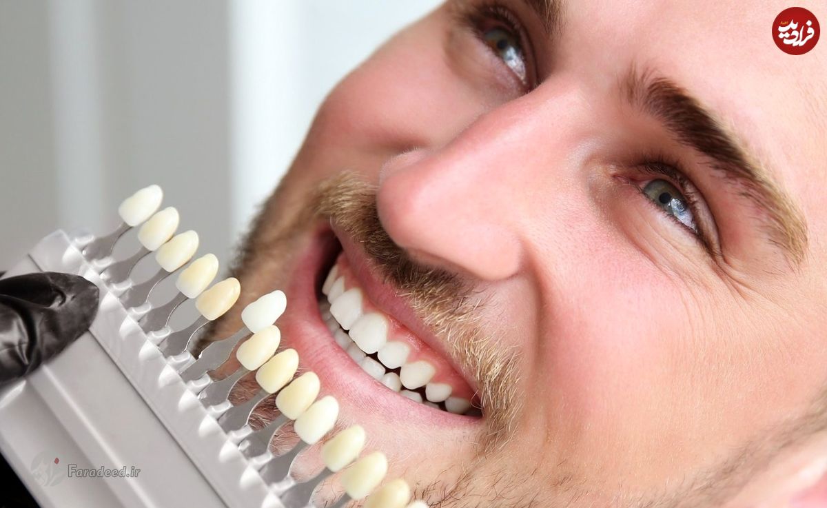راه‌های سفیدی دندان؛ برای سفید شدن دندان چی خوبه؟