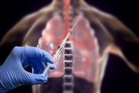 ببینید؛ محققان ایرانی واکسن سرطان ریه را ساختند