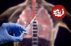 ببینید؛ محققان ایرانی واکسن سرطان ریه را ساختند