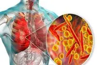 هشدار؛ شیوع دوباره یک بیماری حاد تنفسی در سرما