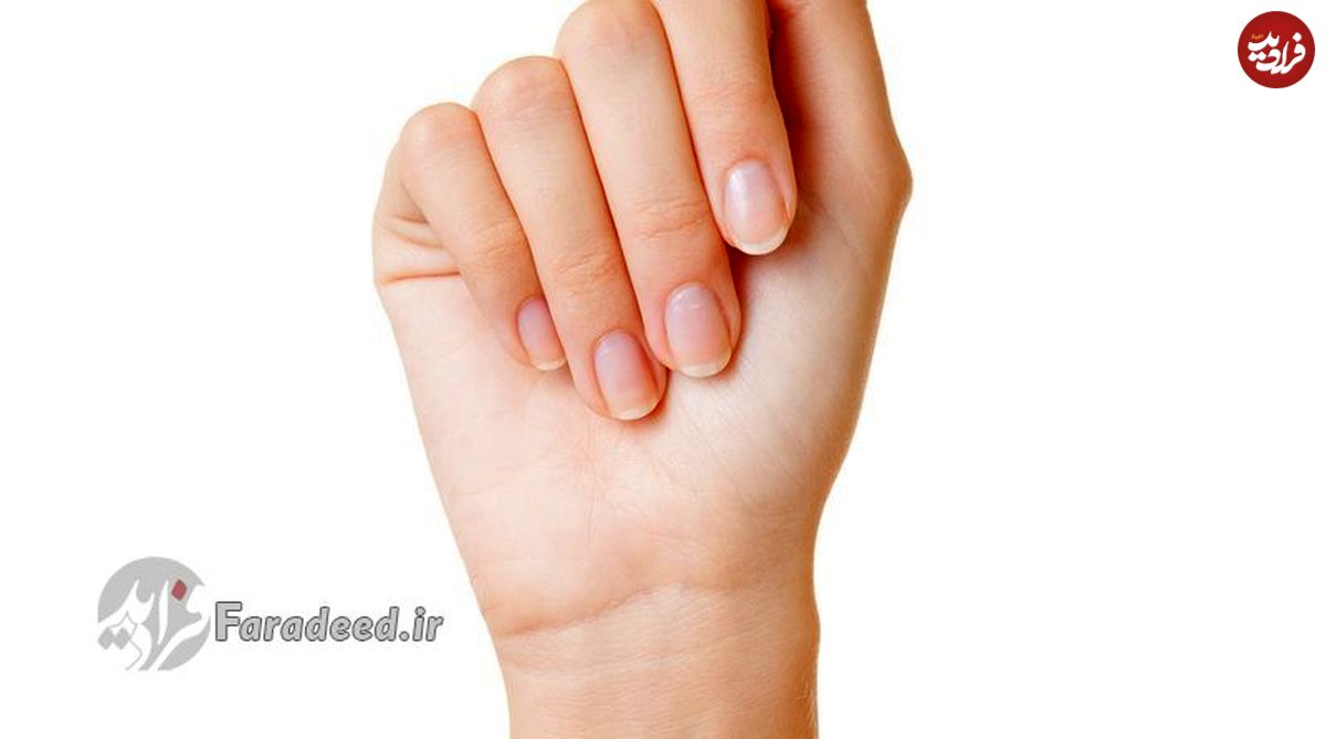سه روش پیشگیری از زردی ناخن
