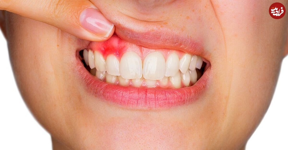 ۱۰ درمان خانگی برای آبسه دندان