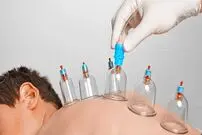 دانستنی‌هایی درباره "انواع حجامت"