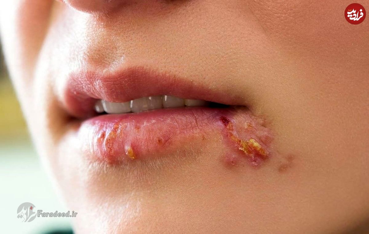زونا چیست و چگونه درمان میشود؟