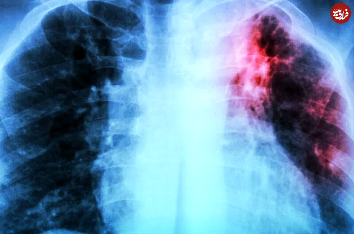 فیبروز ریه در بهبودیافتگان کرونا درمان می‌شود؟