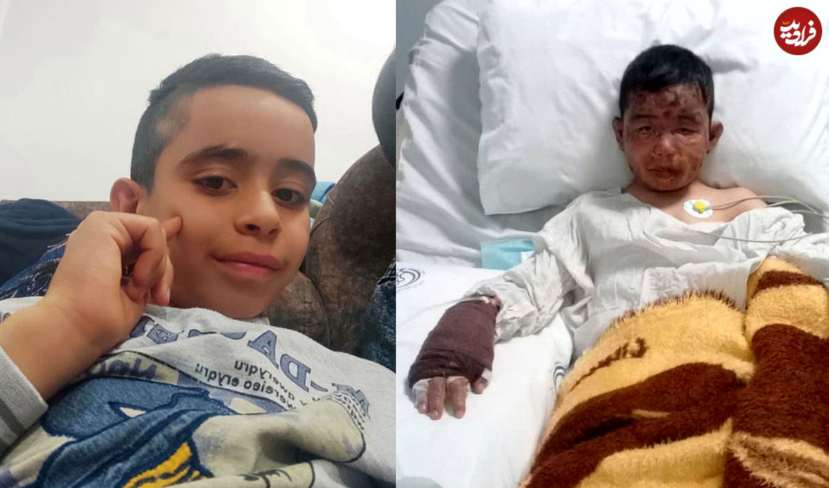 کودک فداکار سوخت تا جان چهار کودک دیگر را نجات دهد
