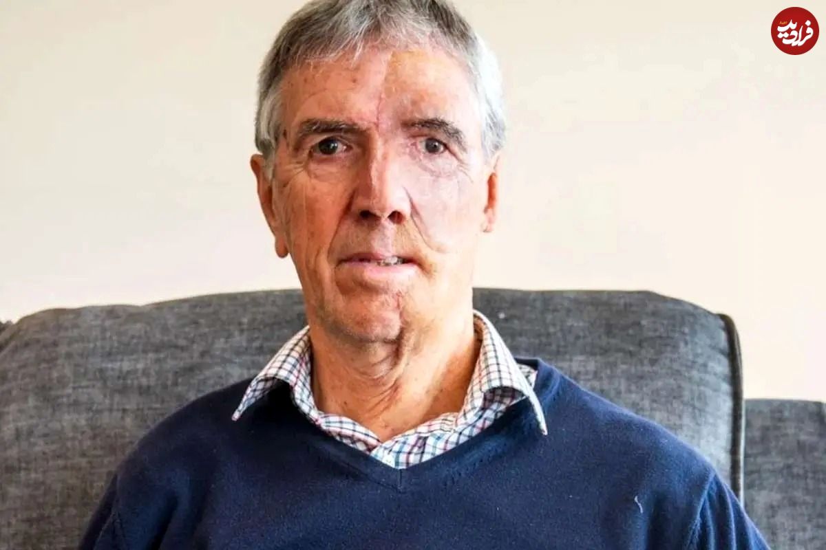 تصاویر؛ بازسازی شگفتانگیز چهره یک دوچرخهسوار پس از تصادف دلخراش