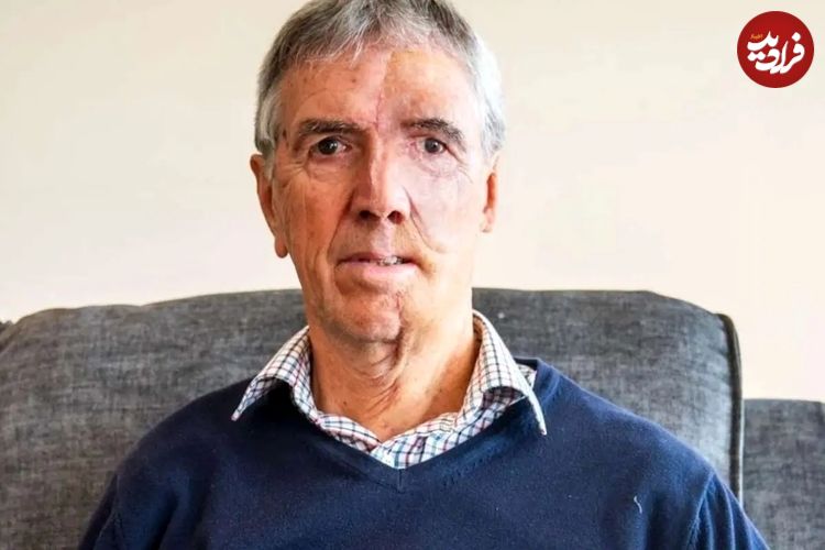 تصاویر؛ بازسازی شگفتانگیز چهره یک دوچرخهسوار پس از تصادف دلخراش