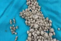 خارج کردن بیش از ۳۰۰ سنگ از کلیه زن جوانی که سال ها آب ننوشیده بود