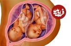چه عواملی باعث دوقلوزایی می‌شود؟