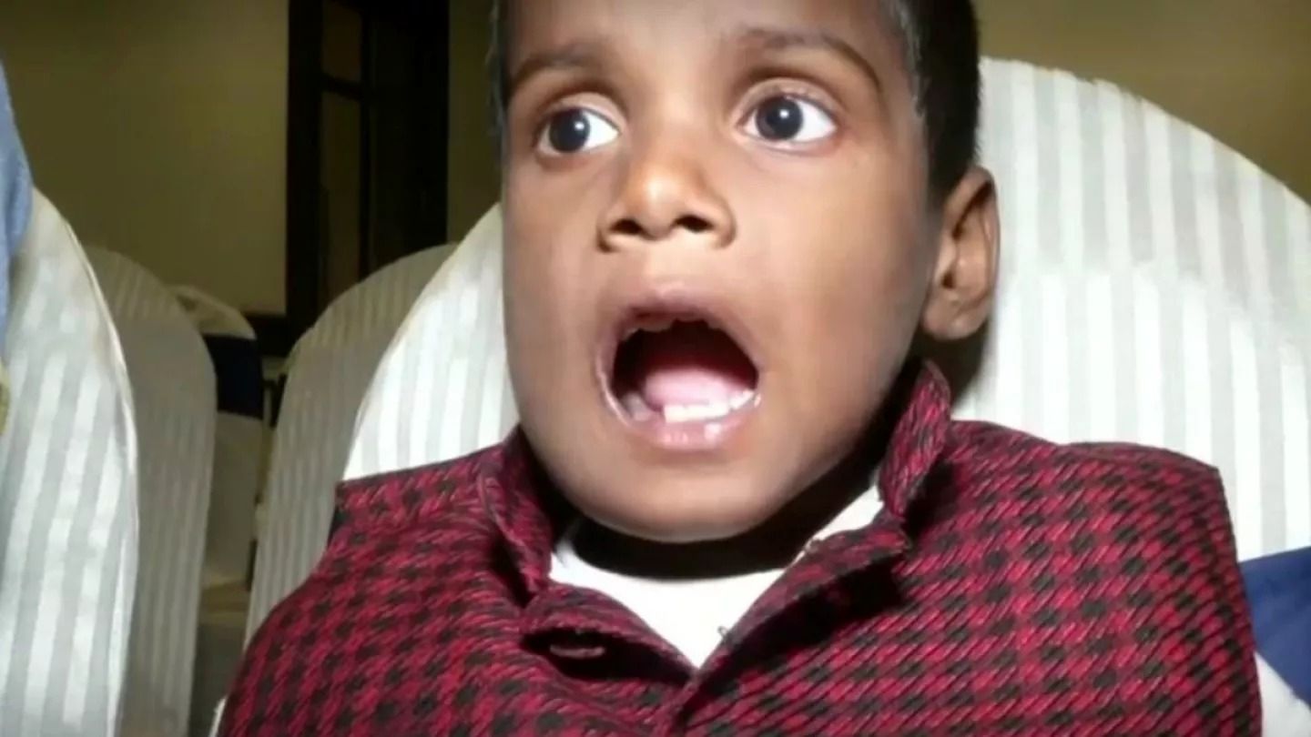 (ویدئو) بیرون کشیدن 526 دندان اضافی از فک این کودک 7 ساله هندی