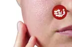 چرا منافذ پوست صورت یک شکل نیستند؟ رازهایی که آینه به شما نمی گوید! + اینفوگرافیک