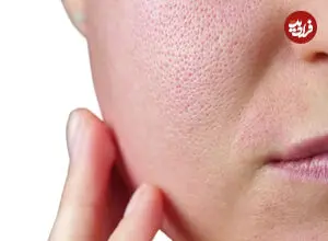 چرا منافذ پوست صورت یک شکل نیستند؟ رازهایی که آینه به شما نمی گوید! + اینفوگرافیک