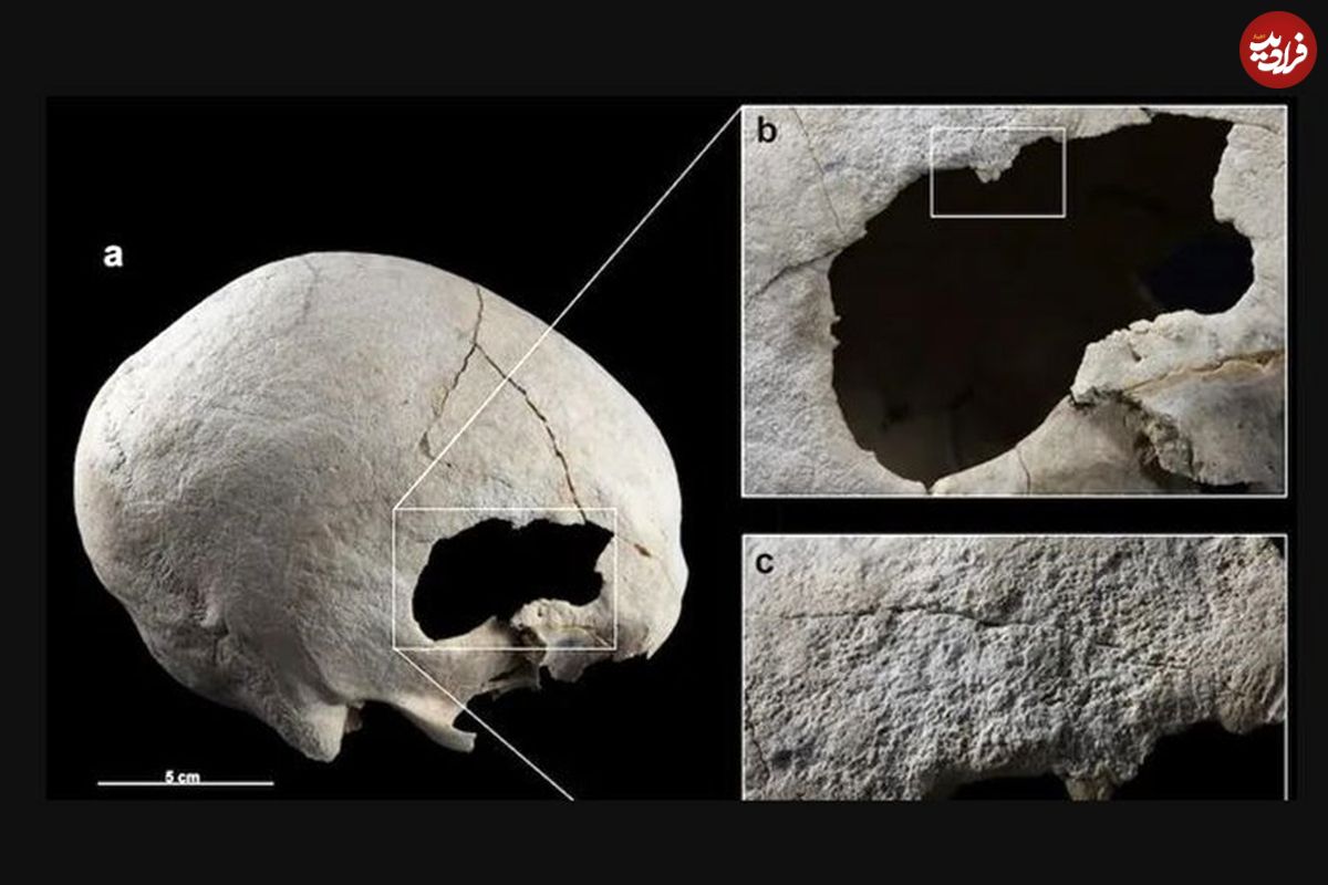 (تصویر) کشف اسکلت زنی که از دو جراحی جمجمه در 4500 سال قبل جان سالم به در برد