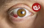 لکه خونی در چشم چقدر خطرناک است؟ چه زمانی باید به پزشک مراجعه کرد؟