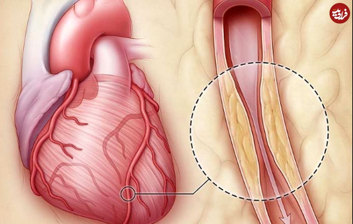 برای باز شدن رگ های قلب چی بخوریم؟