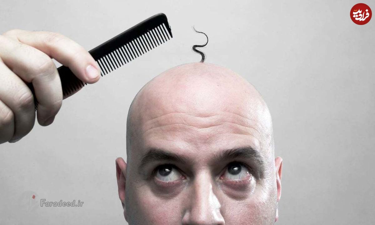 چطور ریزش موی ارثی را درمان کنیم؟