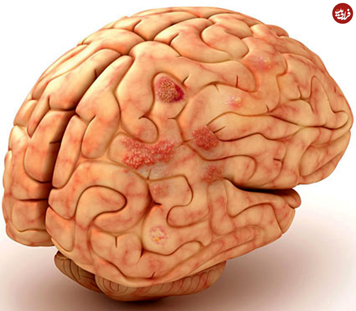 خشکی مغز چیست؟
