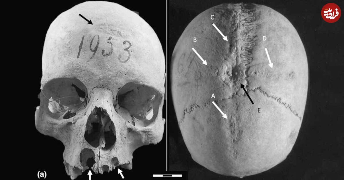 کشف شواهدی از دو جراحی مغز روی جمجمۀ ۱۳۰۰ ساله!