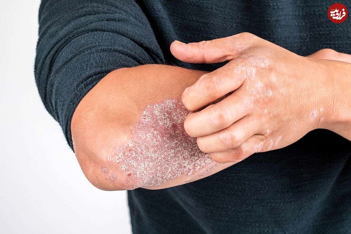 پسوریازیس چیست و چگونه درمان میشود؟