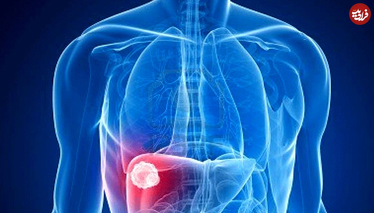 علایم و نشانه‌های سرطان کبد